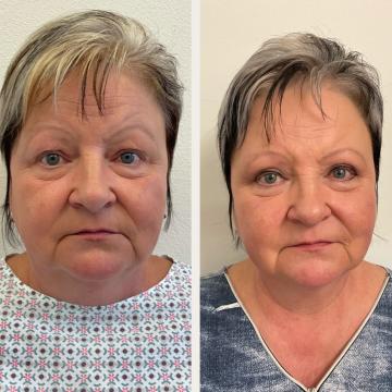 Srovnávací fotky pacientky před a po operaci převislých horních očních víček