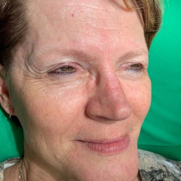Pacientka před úpravou obočí v Centru Oční a estetické medicíny Ottlens 