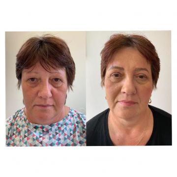 Srovnávací fotka pacient před a po operaci horních očních víček