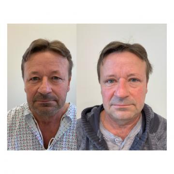 Srovnávací fotky pacienta před a po operaci převislých očních víček