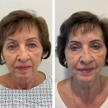 Srovnávací fotky pacientky před a po operaci převislých očních víček