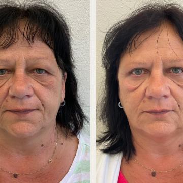 Srovnávací fotky pacientka před a po operaci převislých horních očních víček