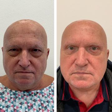Srovnávací fotky pacienta před a po operaci převislých horních a dolních očních víček