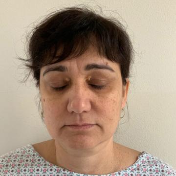 Pacientka před operací převislých horních očních víček
