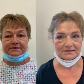 Srovnávací fotky pacientky před a po plastice horních víček a před a po úpravě obočí microbladingem