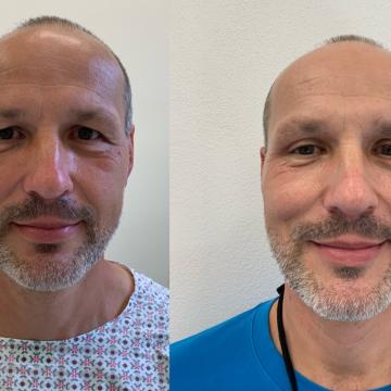Srovnávací fotky pacienta před a po operaci převislých horních očních víček