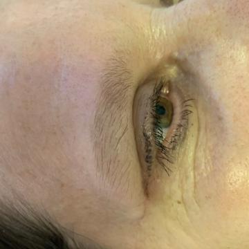 Pacientka před operací převislých horních očních víček a před úpravou obočí
