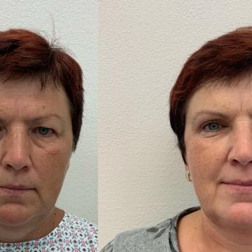 Srovnávací fotky pacientky před a po odstranění převislých horních očních víček