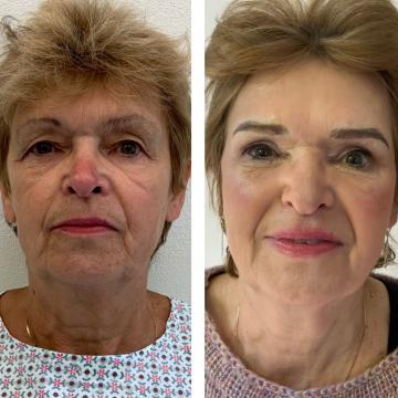 Srovnávací fotky pacientky před a po operaci převislých horních očních víček a po úpravě obočí microbladingem
