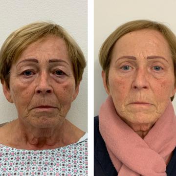 Srovnávací fotky pacientky před a po operaci převislých horních očních víček