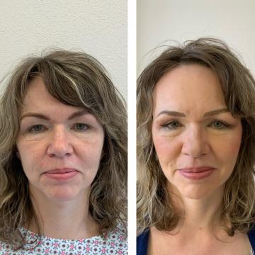 Srovnávací fotky pacientky před a po operaci převislých horních očních víček a po úpravě obočí microbladingem