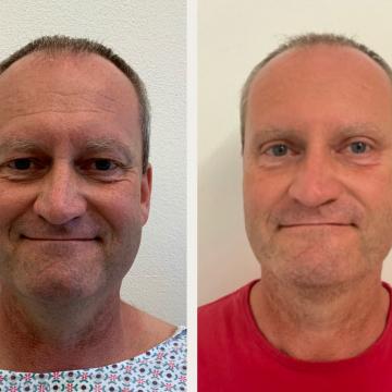 Srovnávací fotky pacient před a po operaci převislých horních očních víček