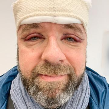 Pacient těsně po operaci převislých očních víček