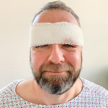 Pacient těsně po operaci převislých očních víček