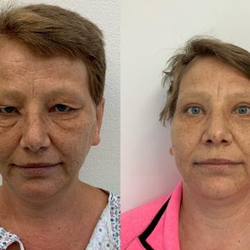 Srovnávací fotky pacientky před a po operaci převislých horních a dolních očních víček