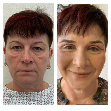 Pacientka před a po operaci převislých horních očních víček