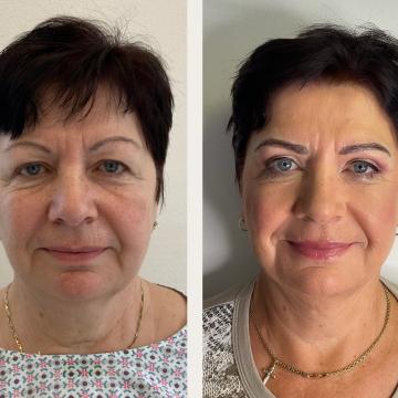 Srovnávací fotka pacientky před a po operaci převislých horních očních víček a úpravě obočí microbladingem