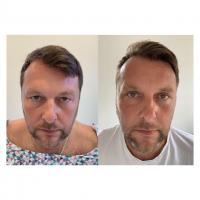 Srovnávací fotka pacient před a po operaci horních očních víček