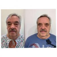 Srovnávací fotky pacienta před a po operaci převislých očních víček