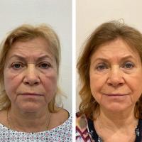 Srovnávací fotky pacientky před a rok po operaci převislých očních víček