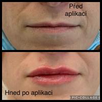 Srovnávací fotka pacientky před a po úpravě rtů výplněmi