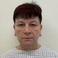 Pacientka před operací převislých horních očních víček, před úpravou obočí a před aplikací výplní
