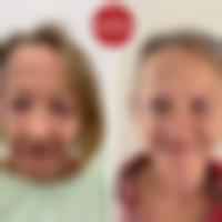 Srovnávací fotka pacientky před a po operaci převislých horních a dolních očních víček