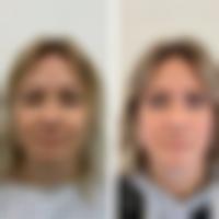Srovnávací fotka pacientky před a po operaci převislých horních očních víček